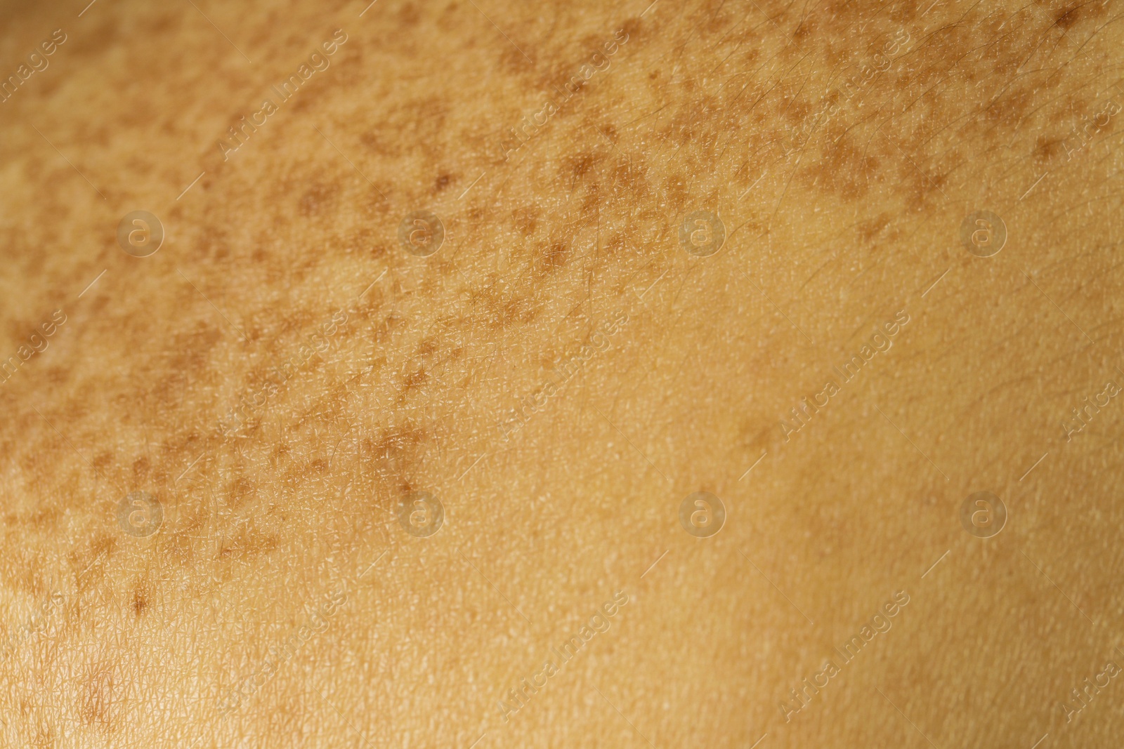 Photo of Texture of human skin as background, closeup view