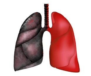 Illustration of  human lungs - healthy and affected by disease on white background