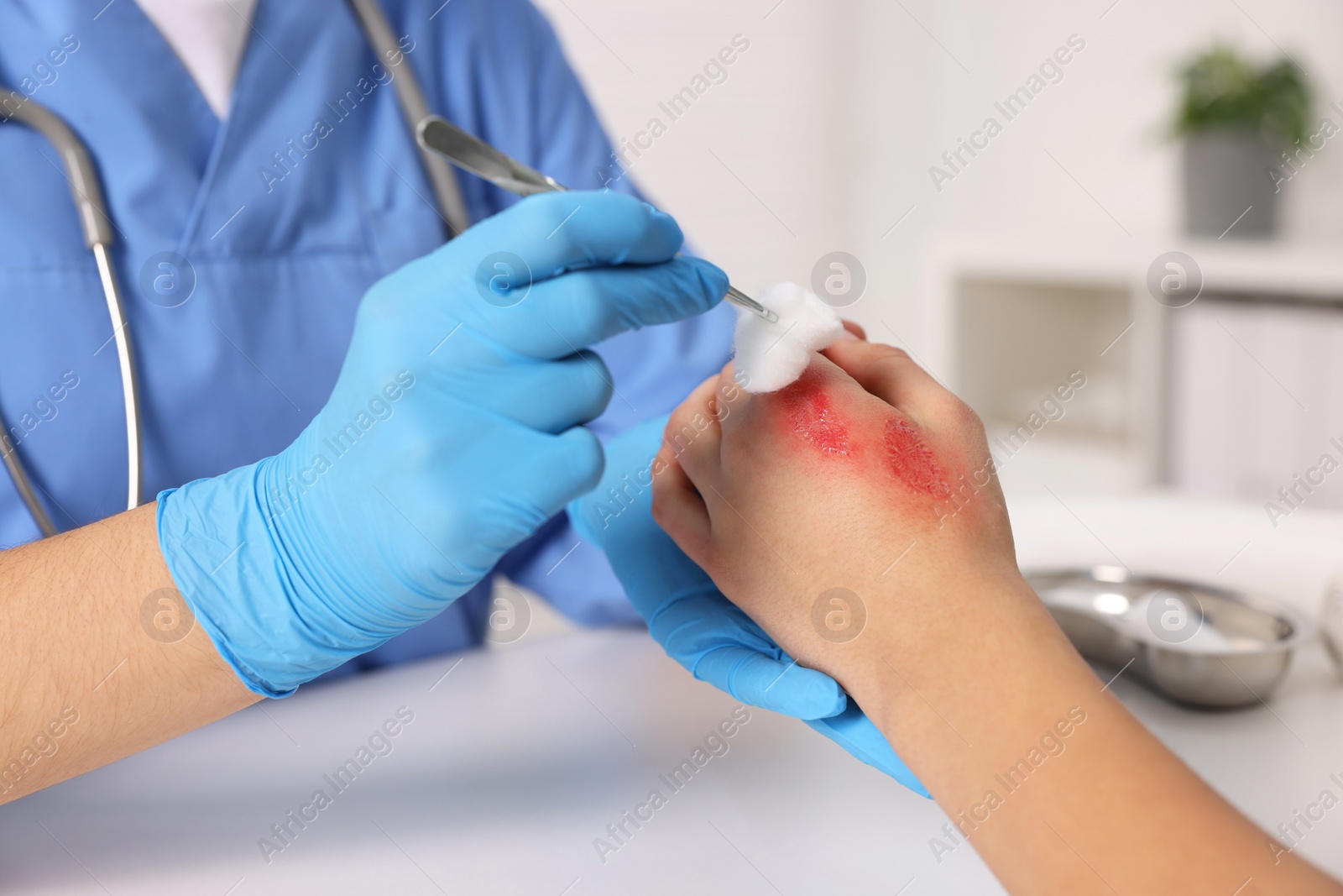 Photo of Doctor treating patient's burned hand at table, closeup