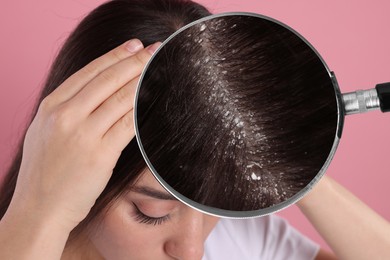 Image of Woman suffering from dandruff on pink background, closeup. View through magnifying glass on hair with flakes