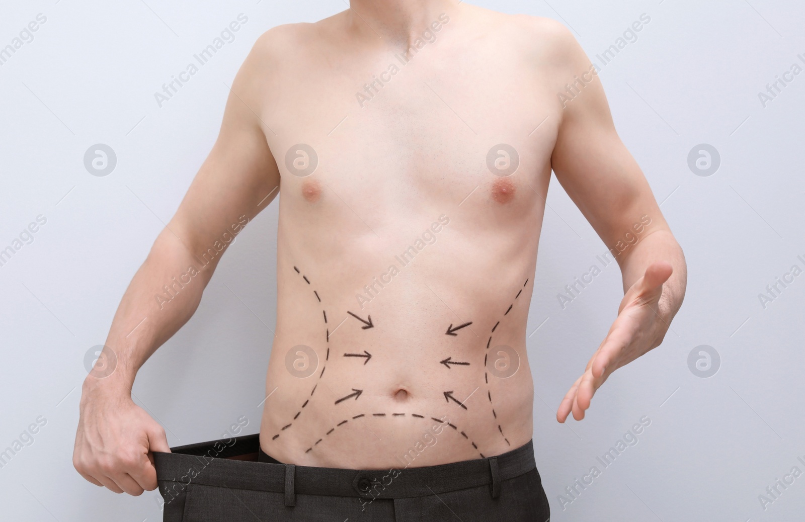 Photo of Young man with marks on belly for cosmetic surgery operation on light background