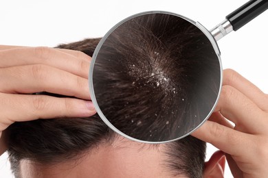 Man suffering from dandruff on white background, closeup. View through magnifying glass on hair with flakes