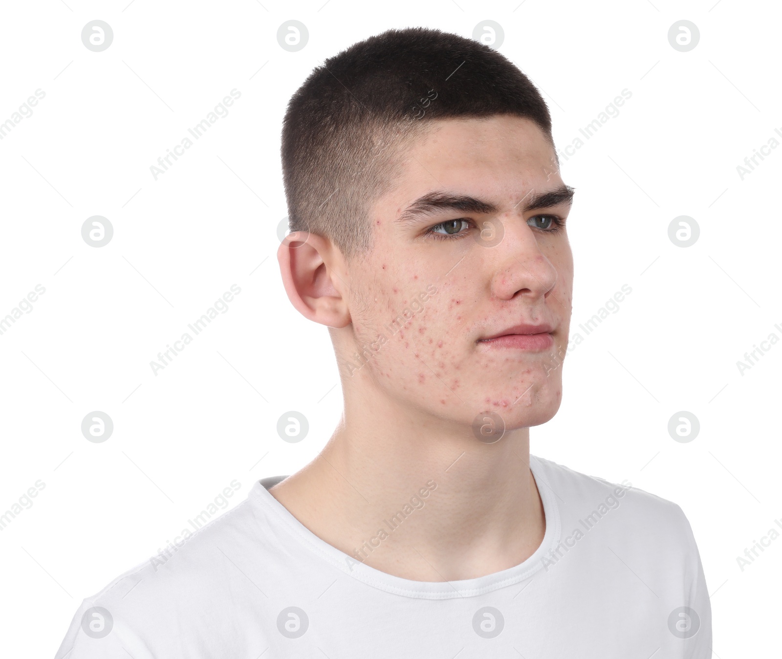 Photo of Young man with acne problem isolated on white