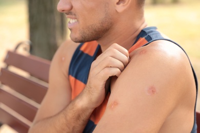 Photo of Man scratching arm with insect bites on bench outdoors, closeup