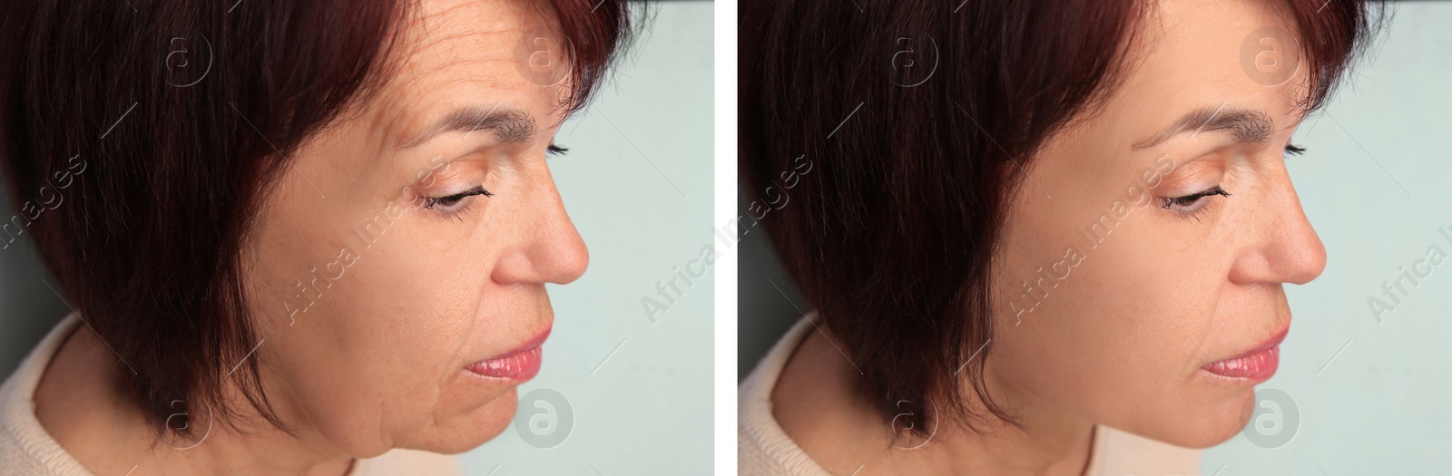 Image of Mature woman looking better due to skin tightening treatments, closeup. Collage with photos before and after on light background