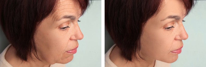 Mature woman looking better due to skin tightening treatments, closeup. Collage with photos before and after on light background
