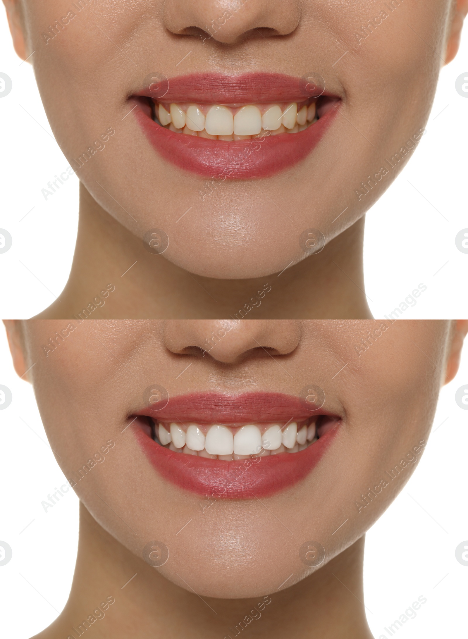 Image of Collage with photos of woman before and after tooth whitening on white background, closeup
