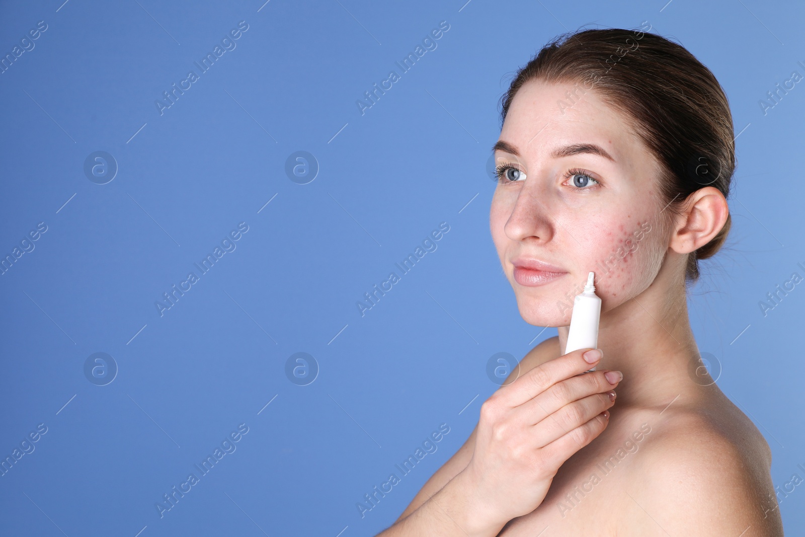 Photo of Young woman with acne problem applying cosmetic product onto her skin on blue background. Space for text