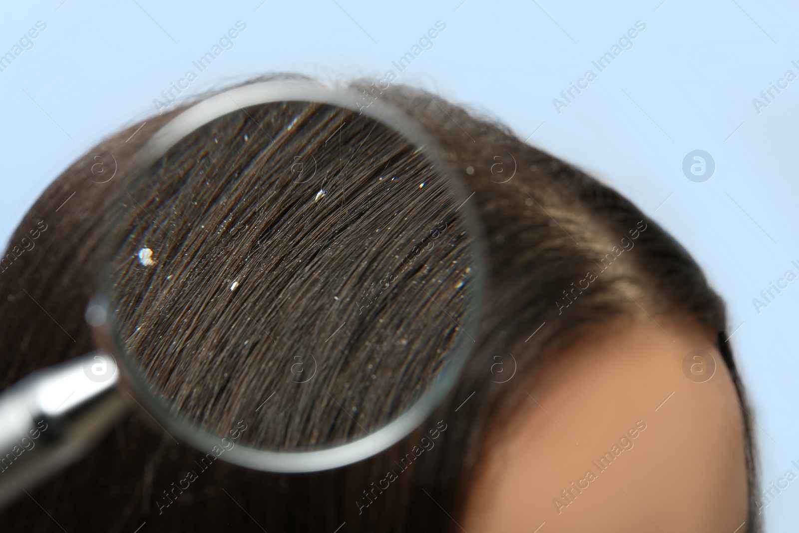 Photo of Closeup of woman with dandruff in her hair on color background, view through magnifying glass