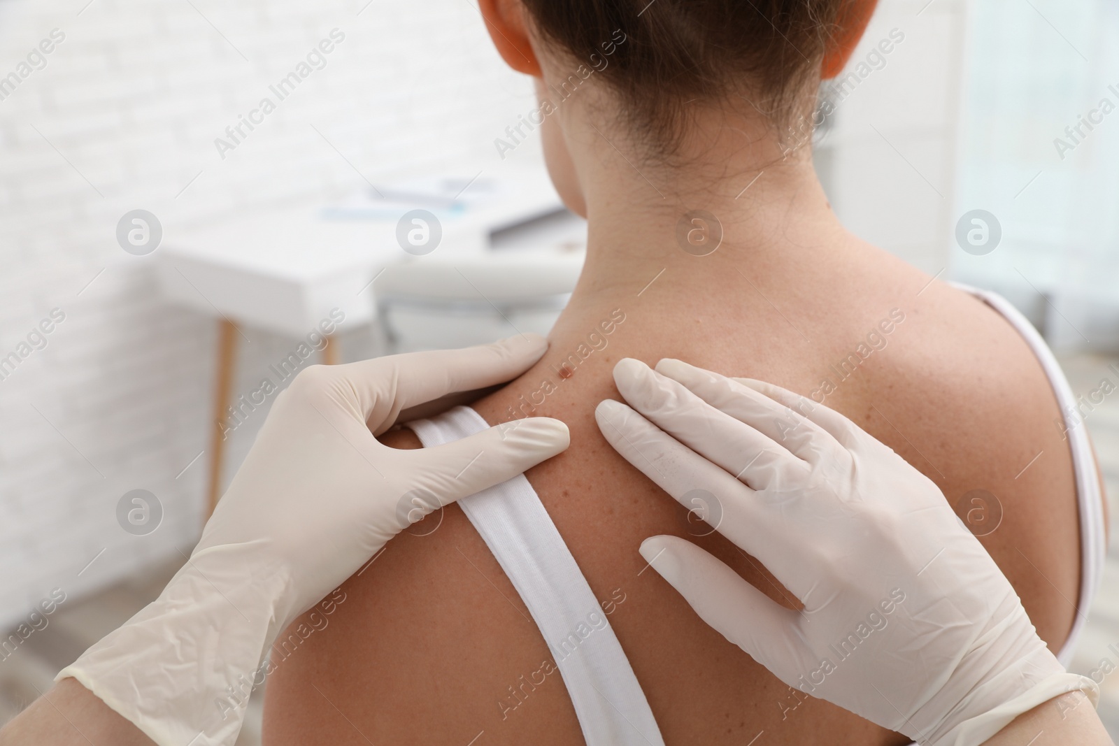 Photo of Dermatologist examining patient's birthmark in clinic, closeup