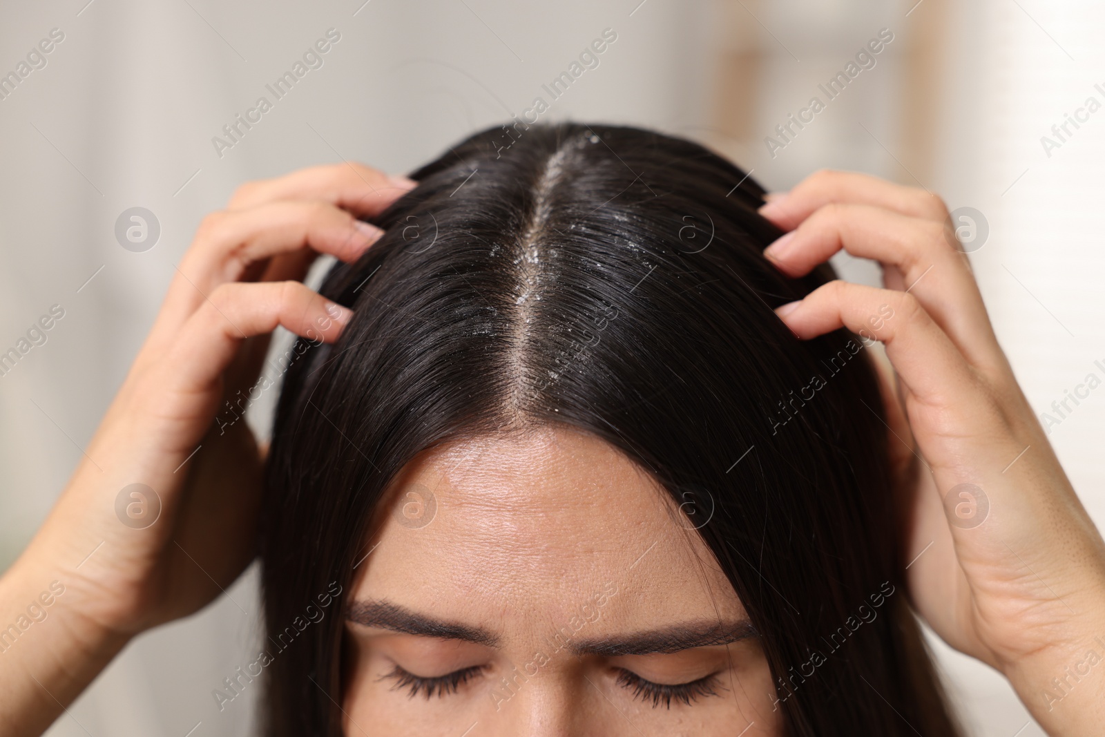 Photo of Woman examining her hair and scalp indoors, closeup. Dandruff problem