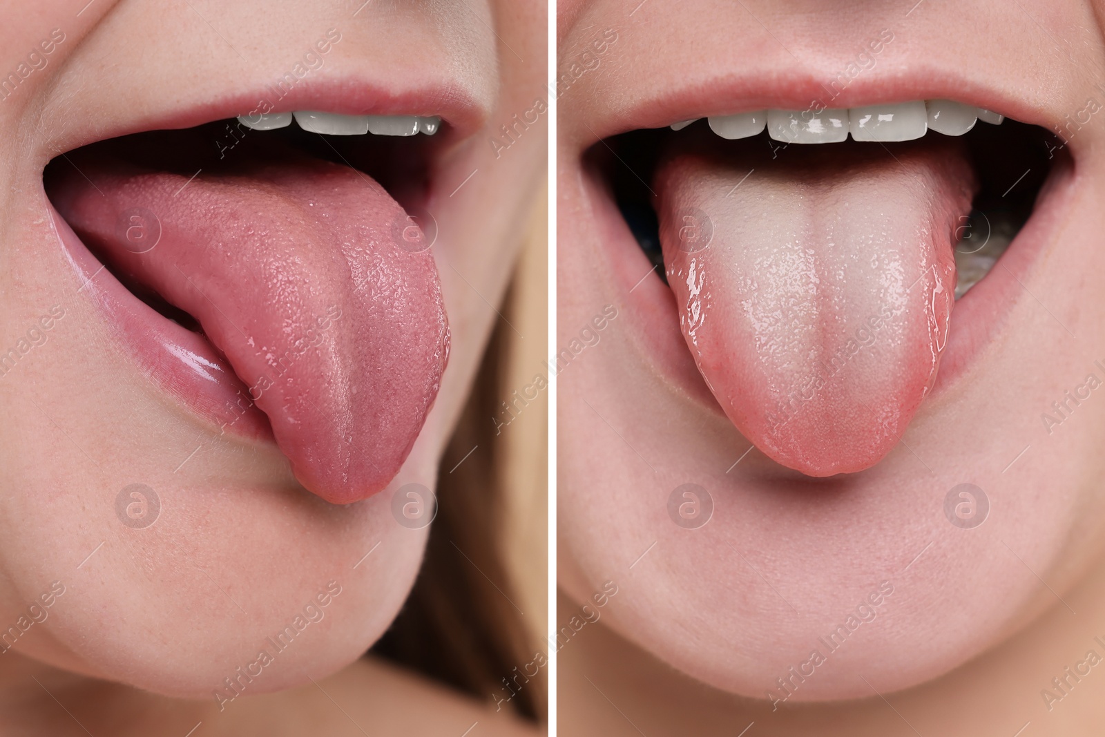 Image of Woman showing her tongue before and after cleaning procedure, closeup. Tongue coated with plaque on one side and healthy on other, collage