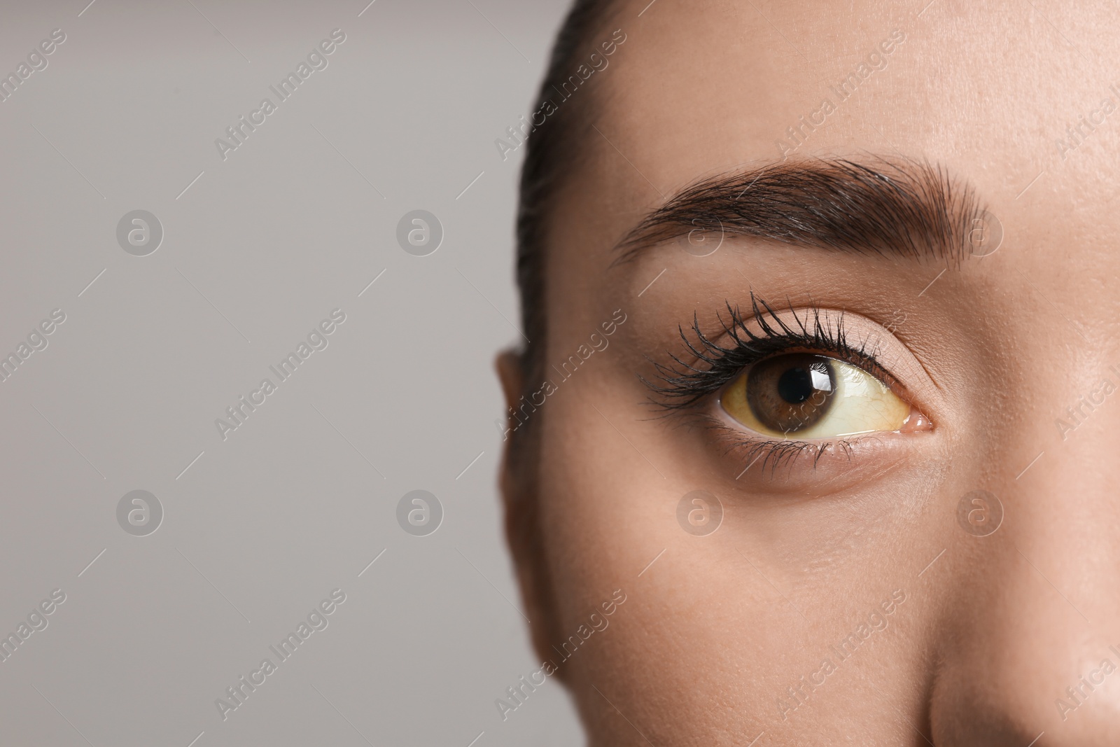 Photo of Woman with yellow eyes on grey background, closeup and space for text. Liver problems symptom