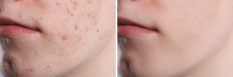 Image of Acne problem. Young man before and after treatment, closeup. Collage of photos