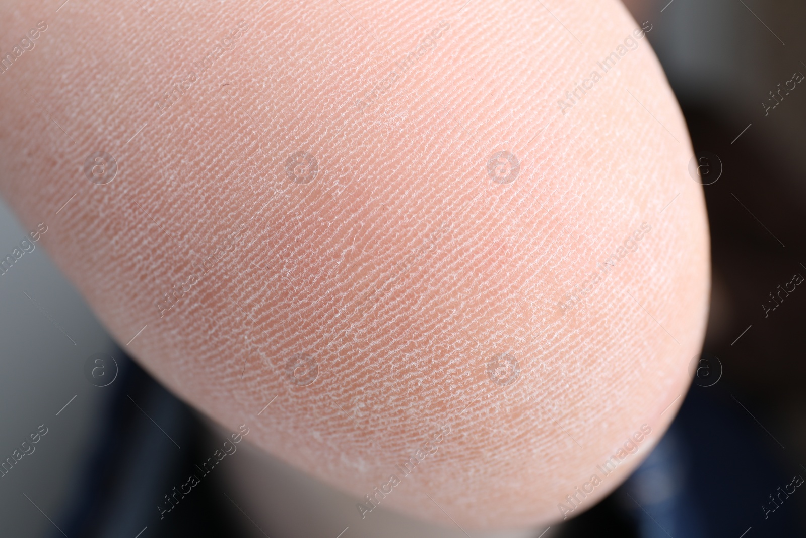 Photo of Woman with dry skin on foot, closeup