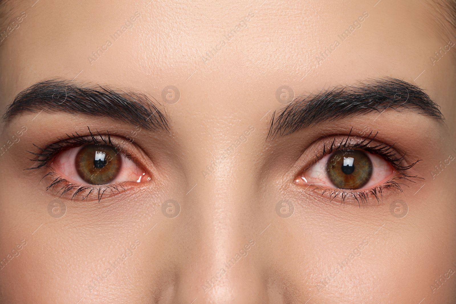 Image of Closeup view of woman with inflamed eyes