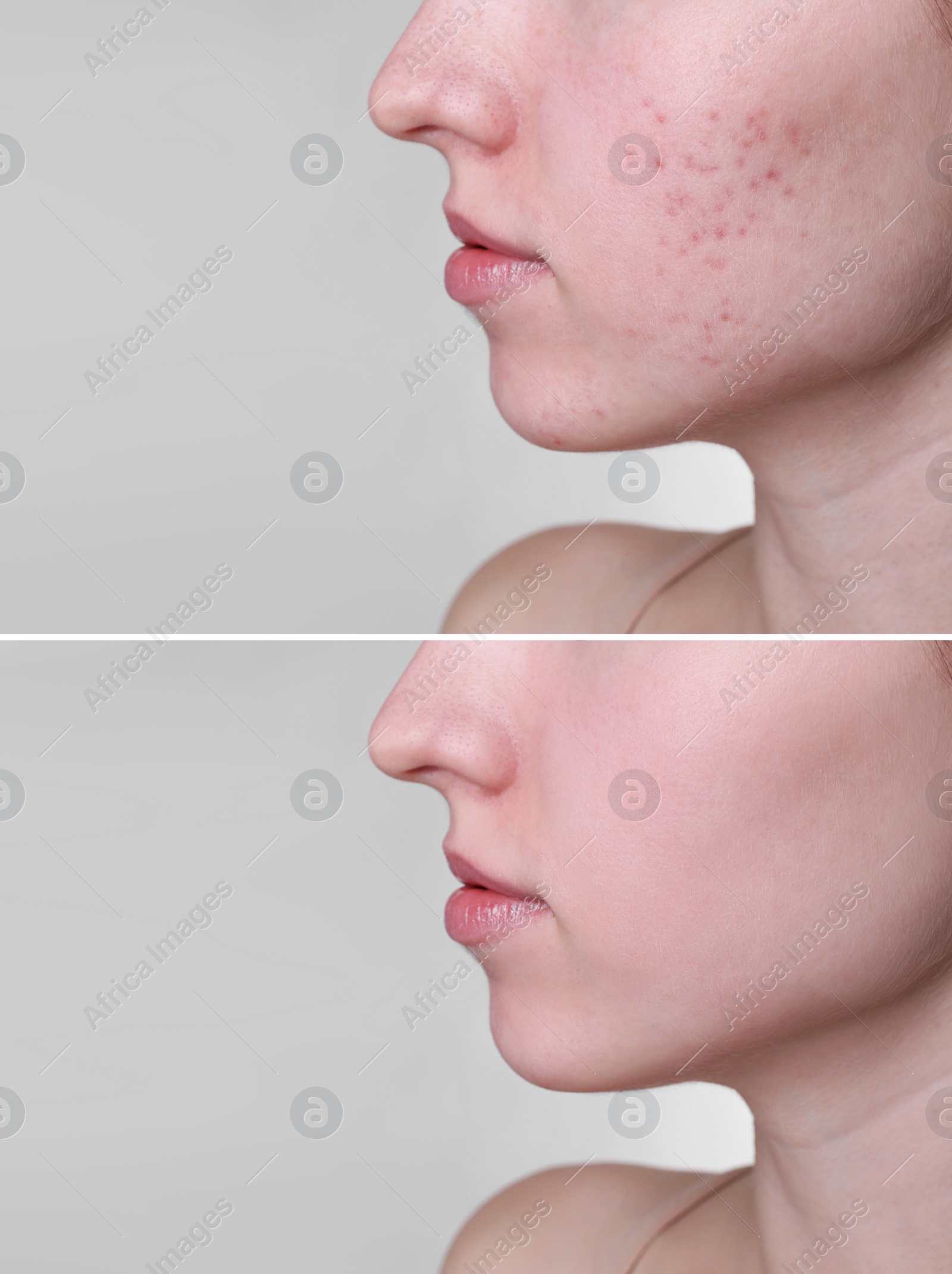 Image of Acne problem. Young woman before and after treatment on light grey background, closeup. Collage of photos