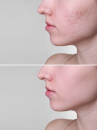 Acne problem. Young woman before and after treatment on light grey background, closeup. Collage of photos