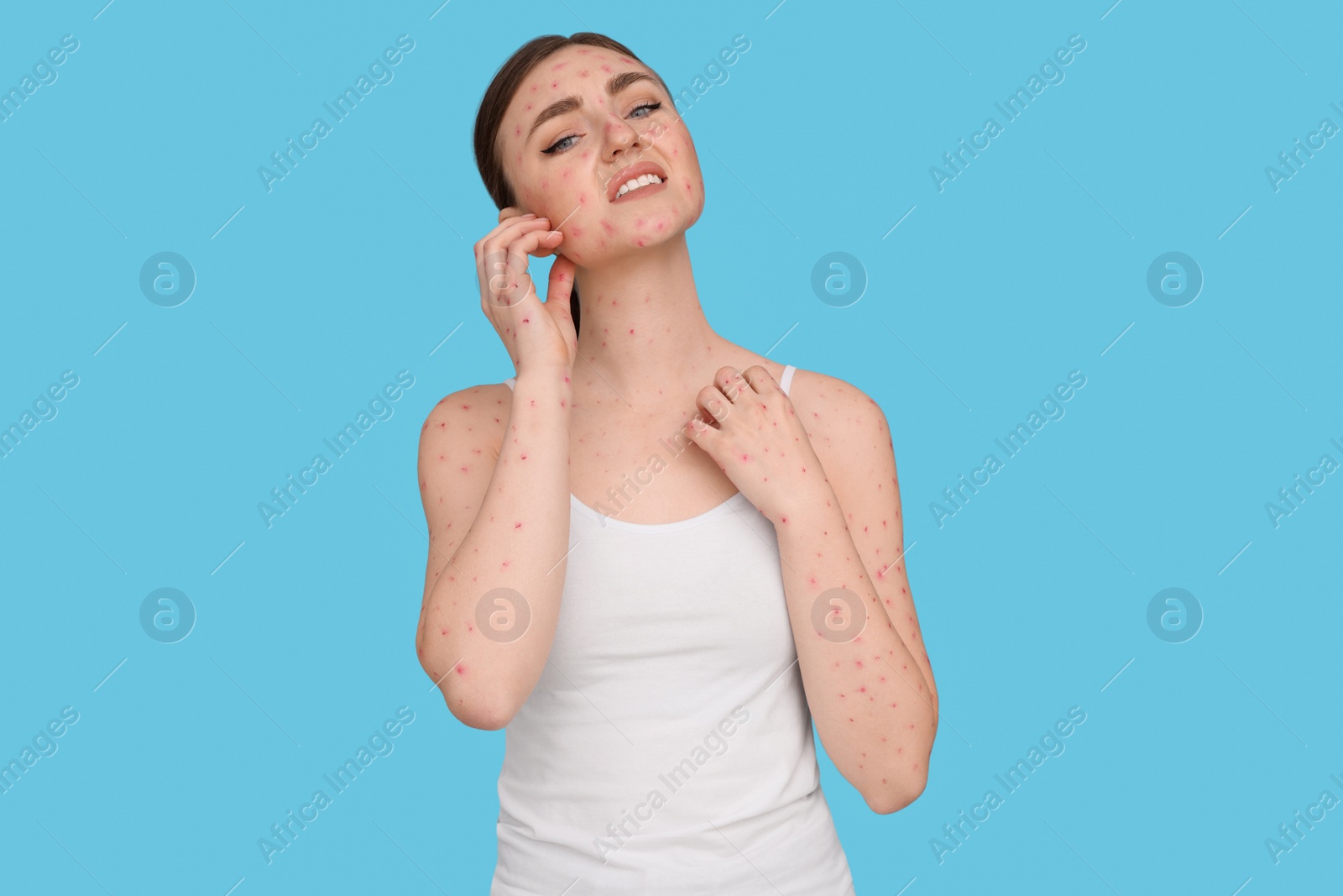 Photo of Woman with rash suffering from monkeypox virus on light blue background