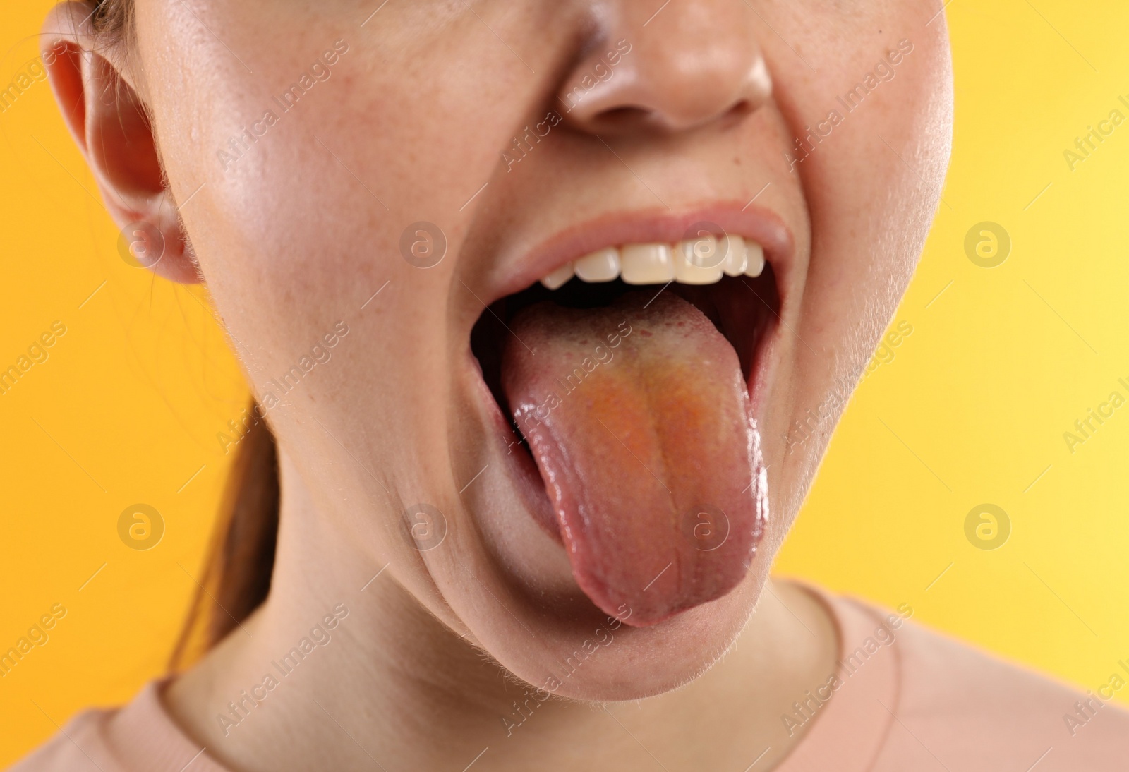 Photo of Gastrointestinal diseases. Woman showing her yellow tongue on color background, closeup