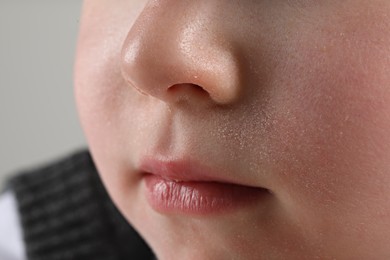 Photo of Little boy with dry skin on face, closeup