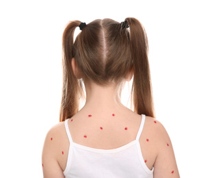 Photo of Little girl with chickenpox on white background
