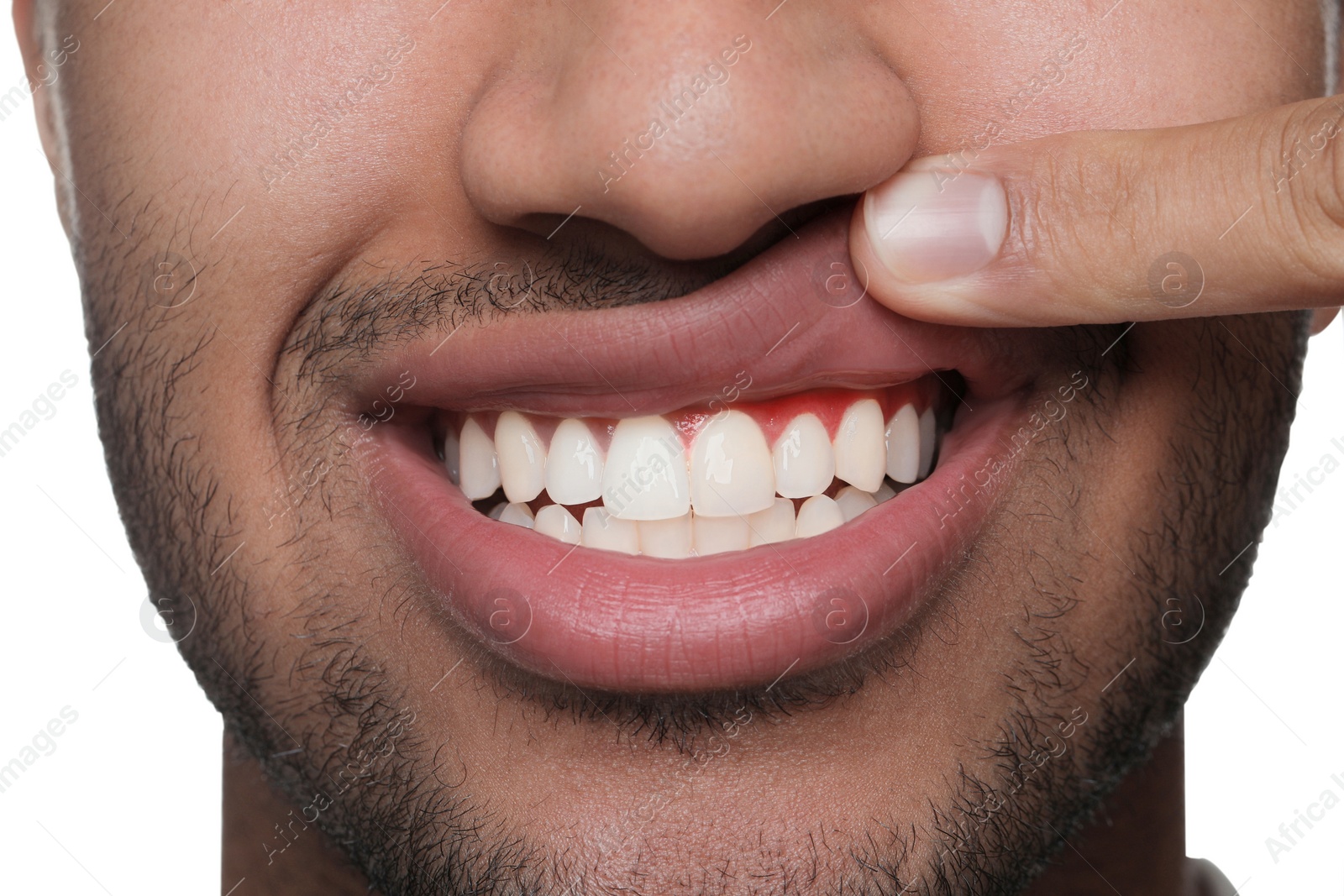 Image of Man showing inflamed gum on white background, closeup