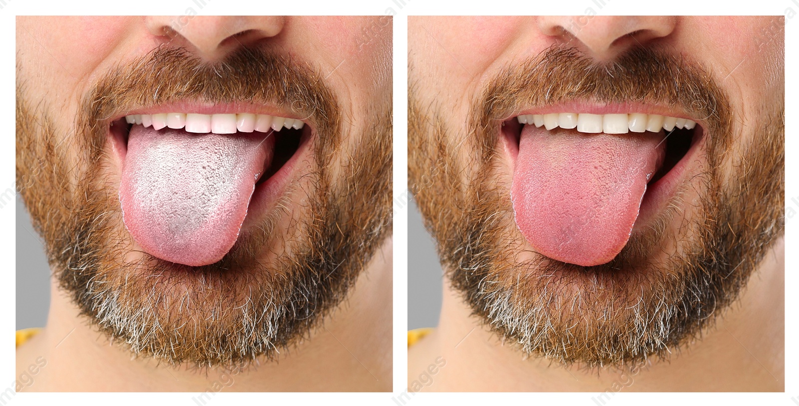 Image of Collage with photos of man before and after tongue cleaning, closeup