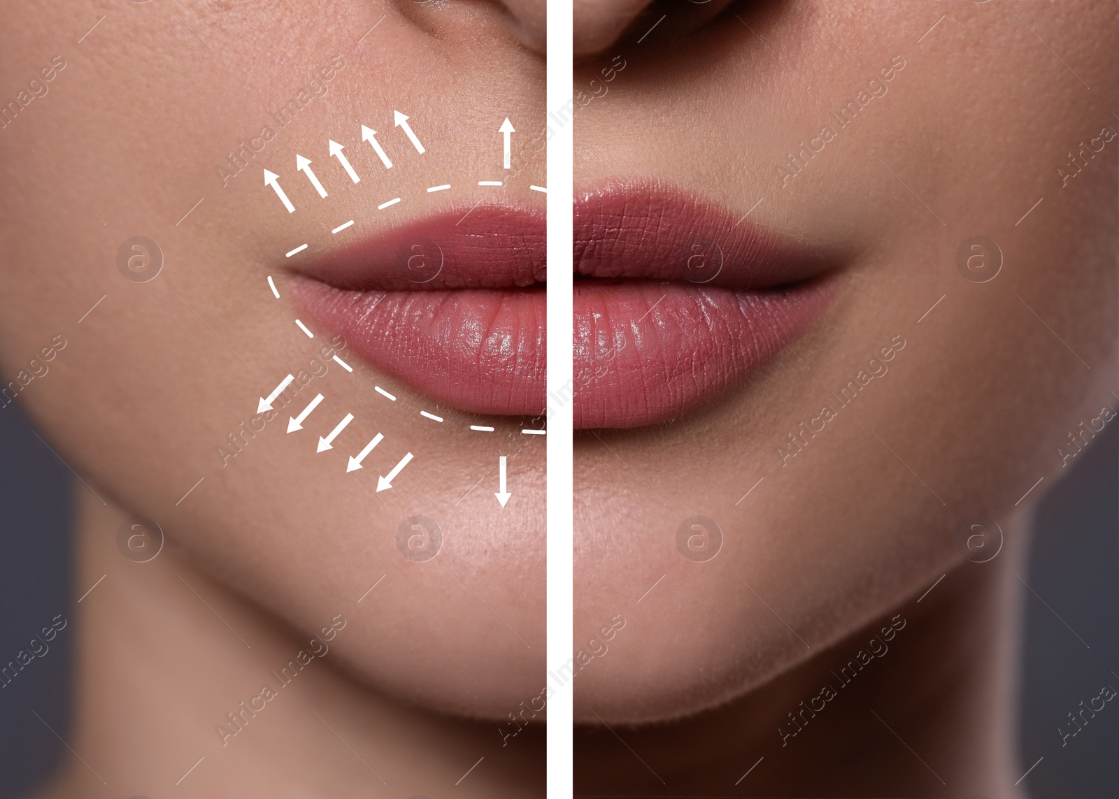 Image of Collage with photos of young woman before and after lips augmentation procedure, closeup