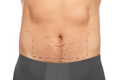 Man with markings on belly before cosmetic surgery operation on white background, closeup