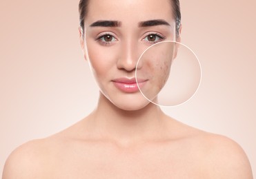 Woman with acne on her face on beige background. Zoomed area showing problem skin