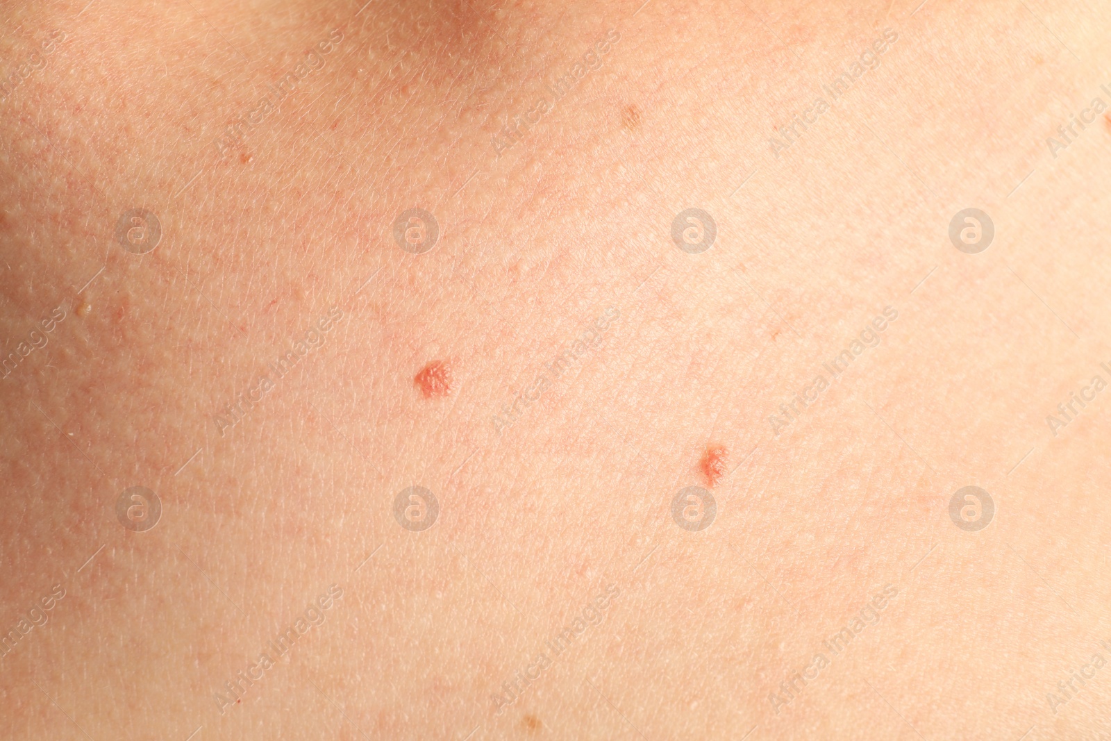Photo of Closeup view of woman's body with birthmarks as background