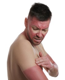 Man with sunburned skin on white background