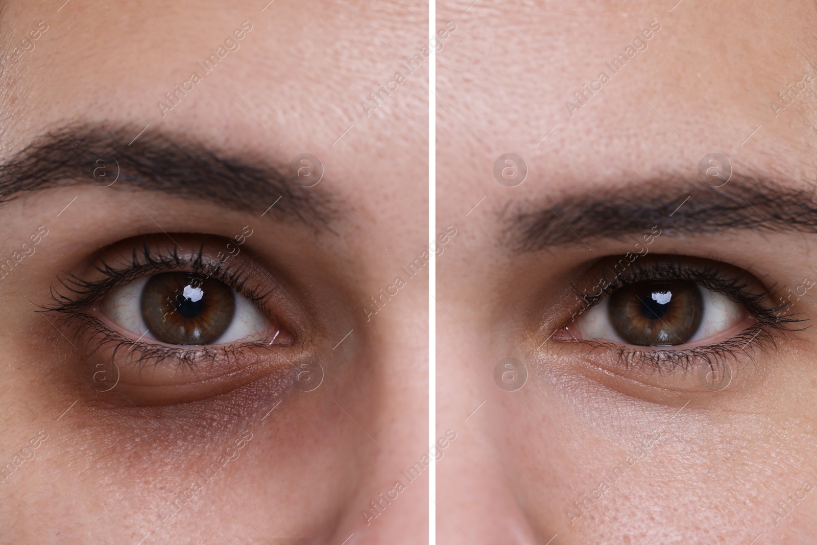 Image of Collage with photos of woman with dark circle under eye before and after treatment, closeup