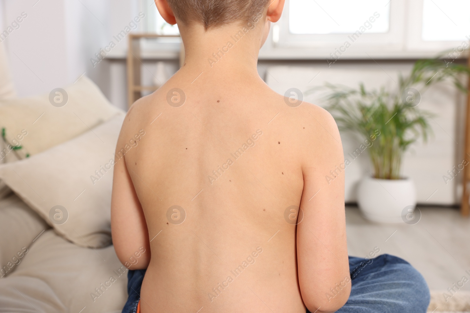 Photo of Closeup of boy's body with birthmarks in living room, back view