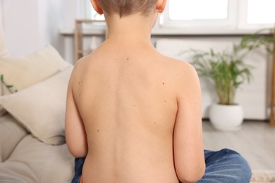 Photo of Closeup of boy's body with birthmarks in living room, back view