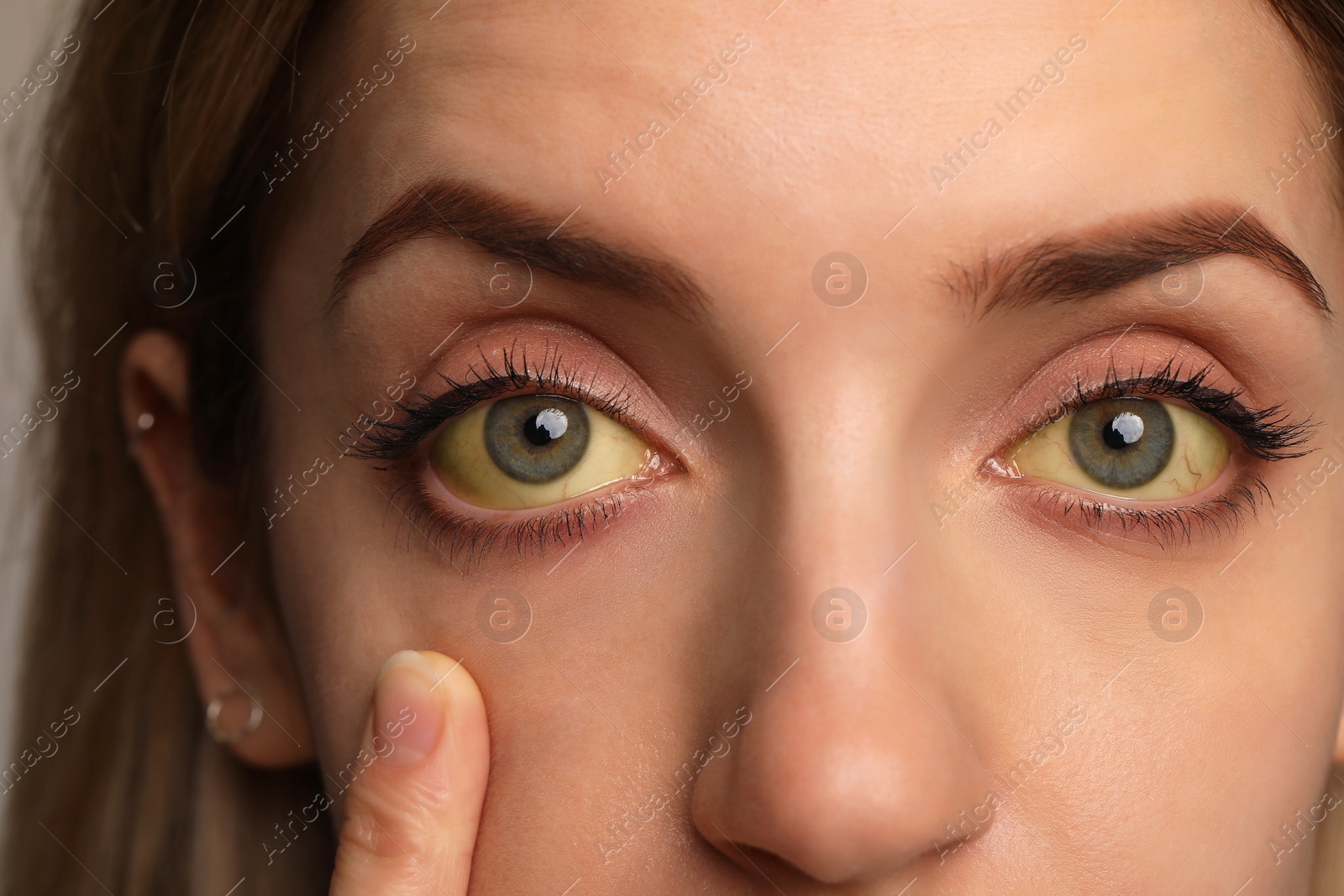 Photo of Woman checking her health condition, closeup. Yellow eyes as symptom of problems with liver