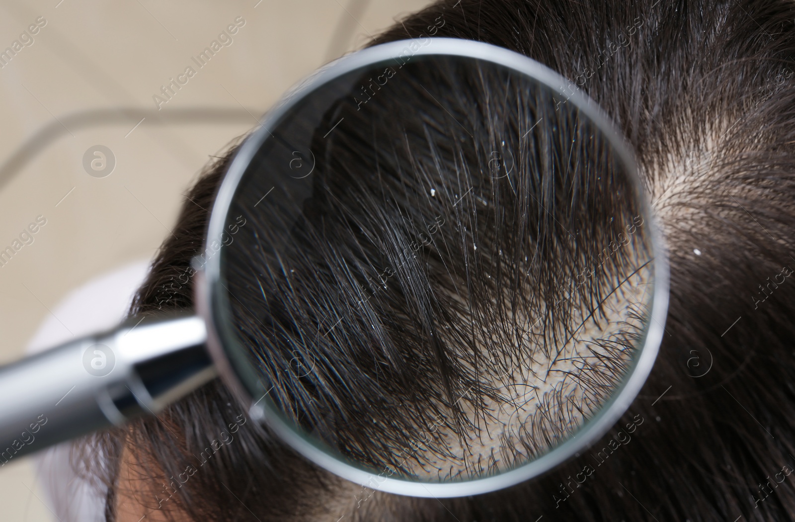 Photo of Closeup of woman with dandruff in her hair, view through magnifying glass