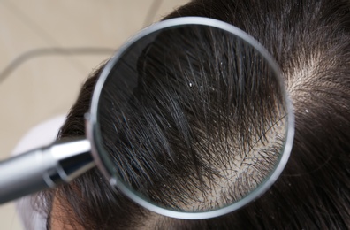 Photo of Closeup of woman with dandruff in her hair, view through magnifying glass