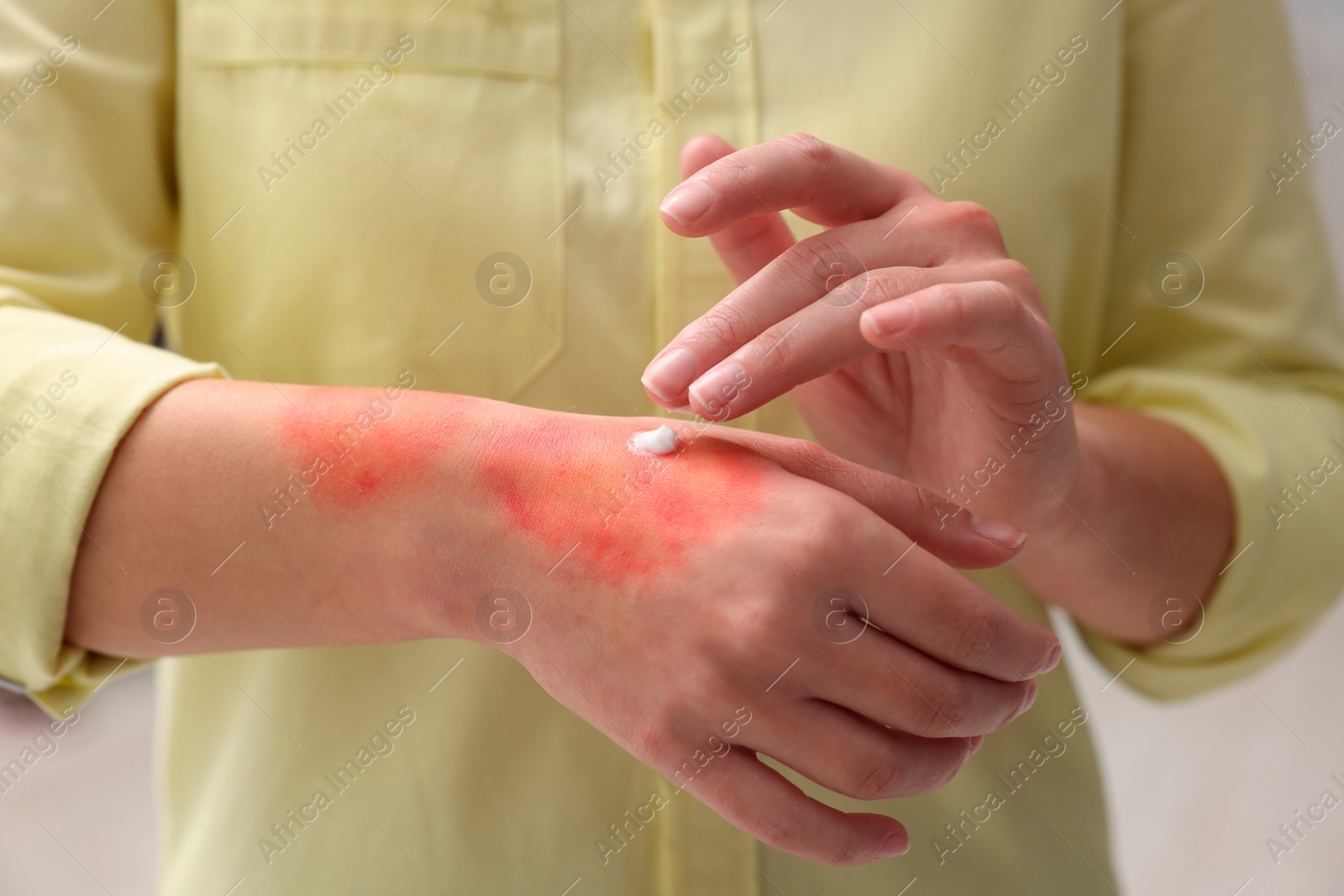 Photo of Woman applying healing cream onto burned hand indoors, closeup