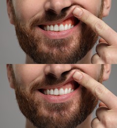 Image of Man showing gum before and after treatment on grey background, collage of photos