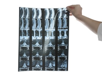 Photo of Doctor examining neck MRI image on white background, closeup