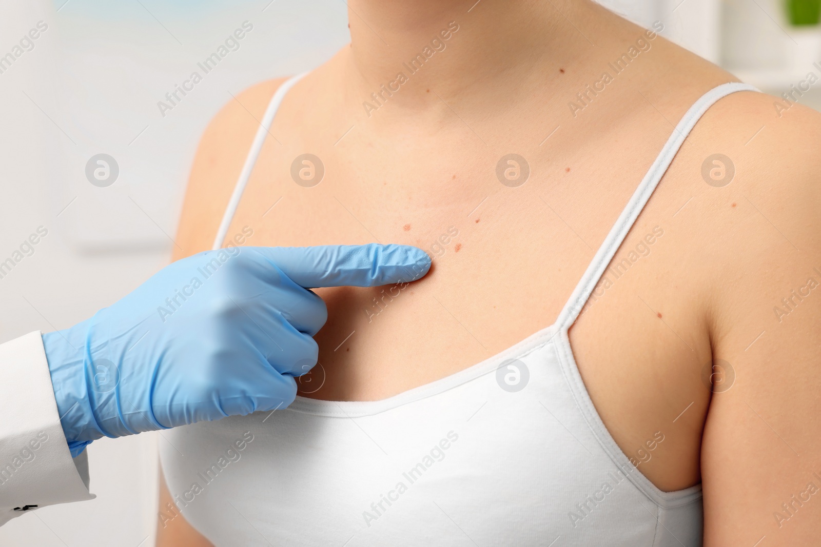 Photo of Dermatologist examining patient's birthmark indoors, closeup view