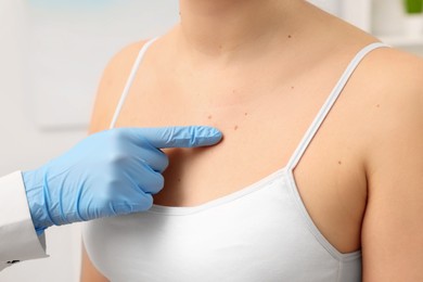 Dermatologist examining patient's birthmark indoors, closeup view