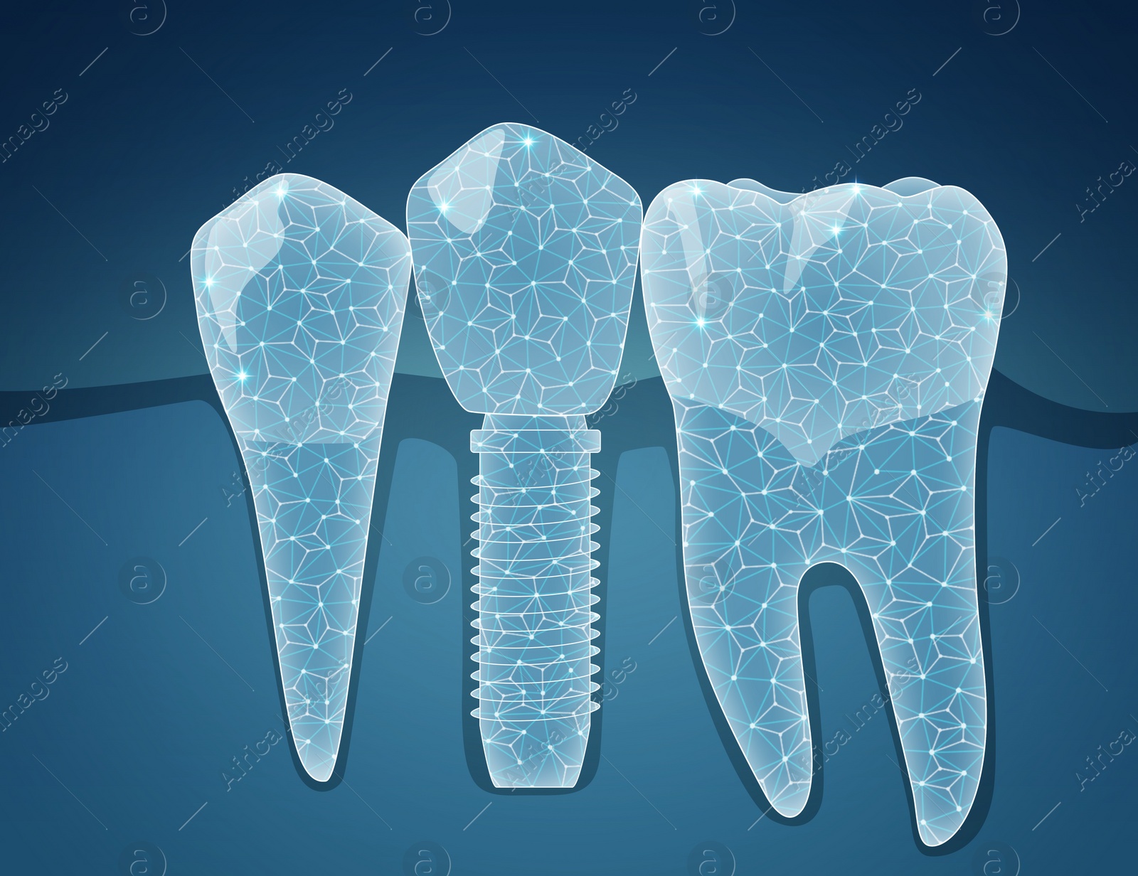 Illustration of  teeth and dental implant on blue background