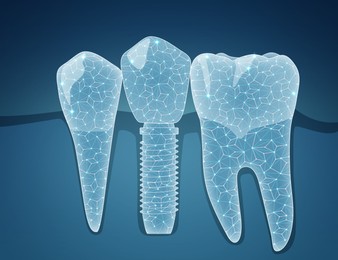 Illustration of  teeth and dental implant on blue background