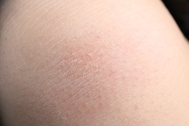 Photo of Closeup view of woman with dry skin