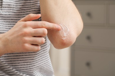 Photo of Man applying ointment onto his elbow indoors, closeup