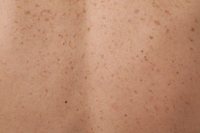 Closeup of man's body with birthmarks as background