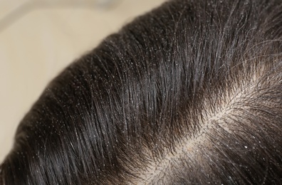 Photo of Woman with dandruff in her dark hair, closeup view